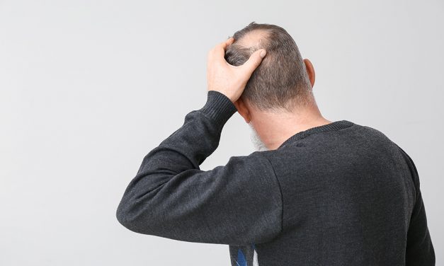 Der blanke Horror, gerade für Männer: Kreisrunder Haarausfall!