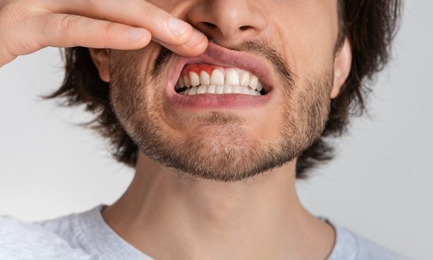 Zahnfleischentzündung – viele sind betroffen