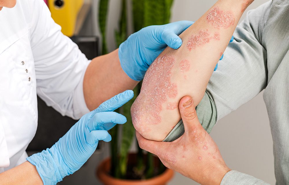 Psoriasis – die häufigsten Fragen zu Schuppenflechte