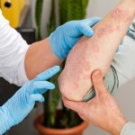 Psoriasis – die häufigsten Fragen zu Schuppenflechte