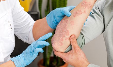 Psoriasis – die häufigsten Fragen zu Schuppenflechte