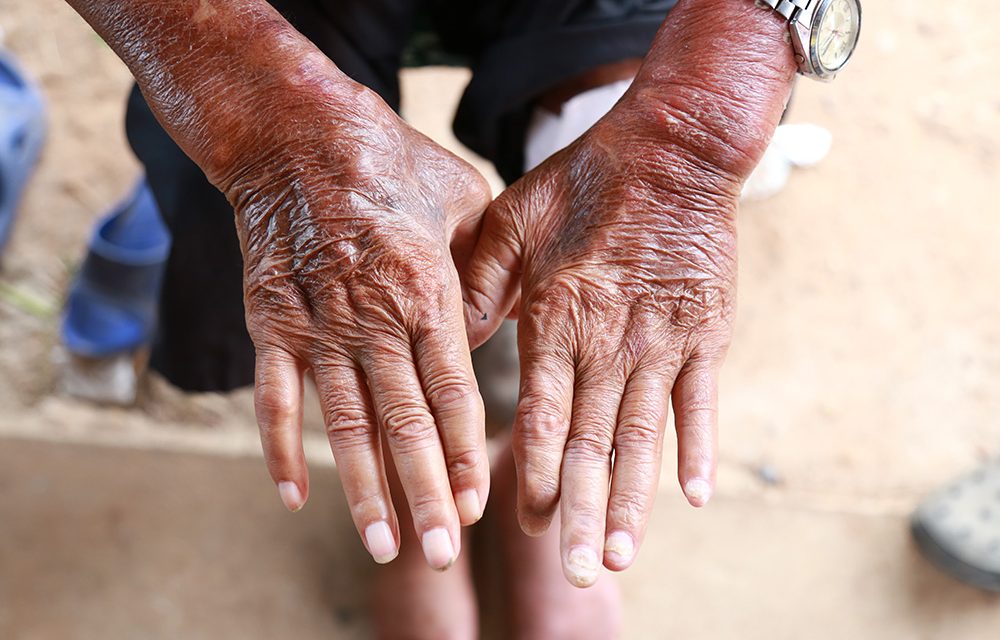 Sklerodermie – Harte Haut