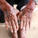 Sklerodermie – Harte Haut