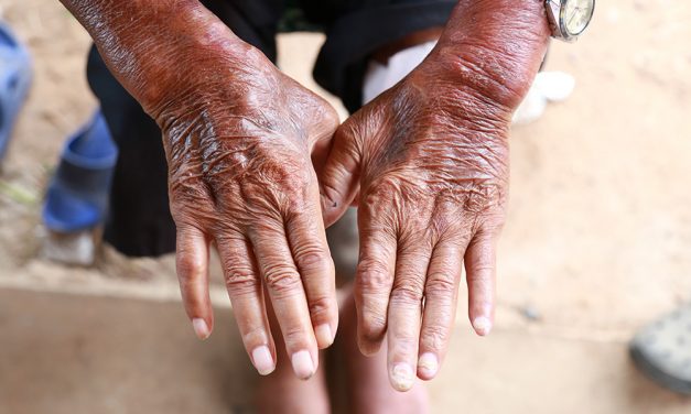 Sklerodermie – Harte Haut