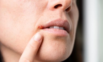 Lippenherpes in der Urlaubszeit