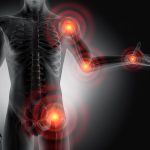 Rheumatoide Arthritis – schmerzhafte Entzündung in den Gelenken