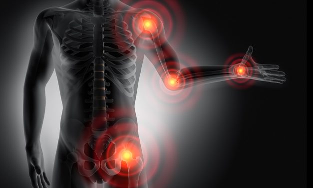 Rheumatoide Arthritis – schmerzhafte Entzündung in den Gelenken