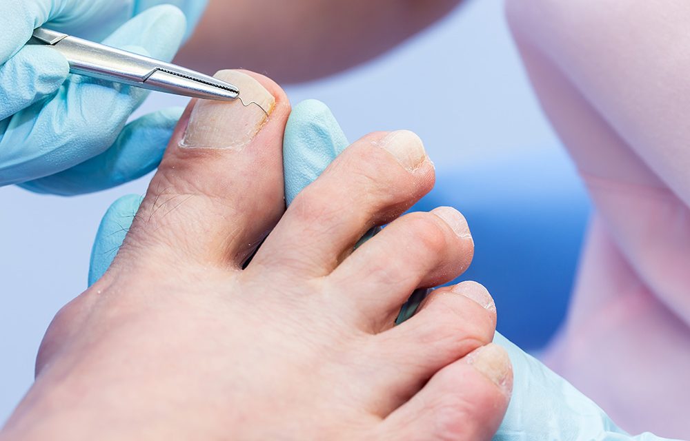 Eingewachsene Nägel – wenn jeder Schritt schmerzt