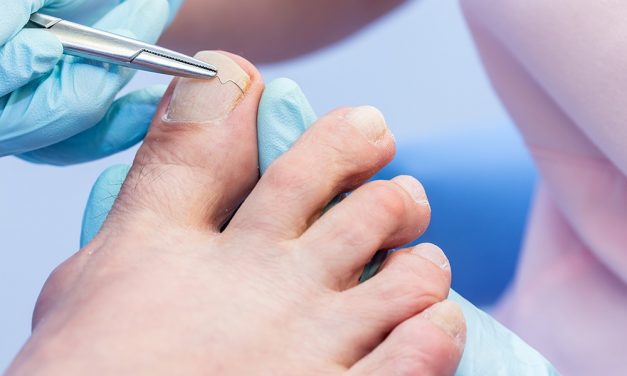 Eingewachsene Nägel – wenn jeder Schritt schmerzt
