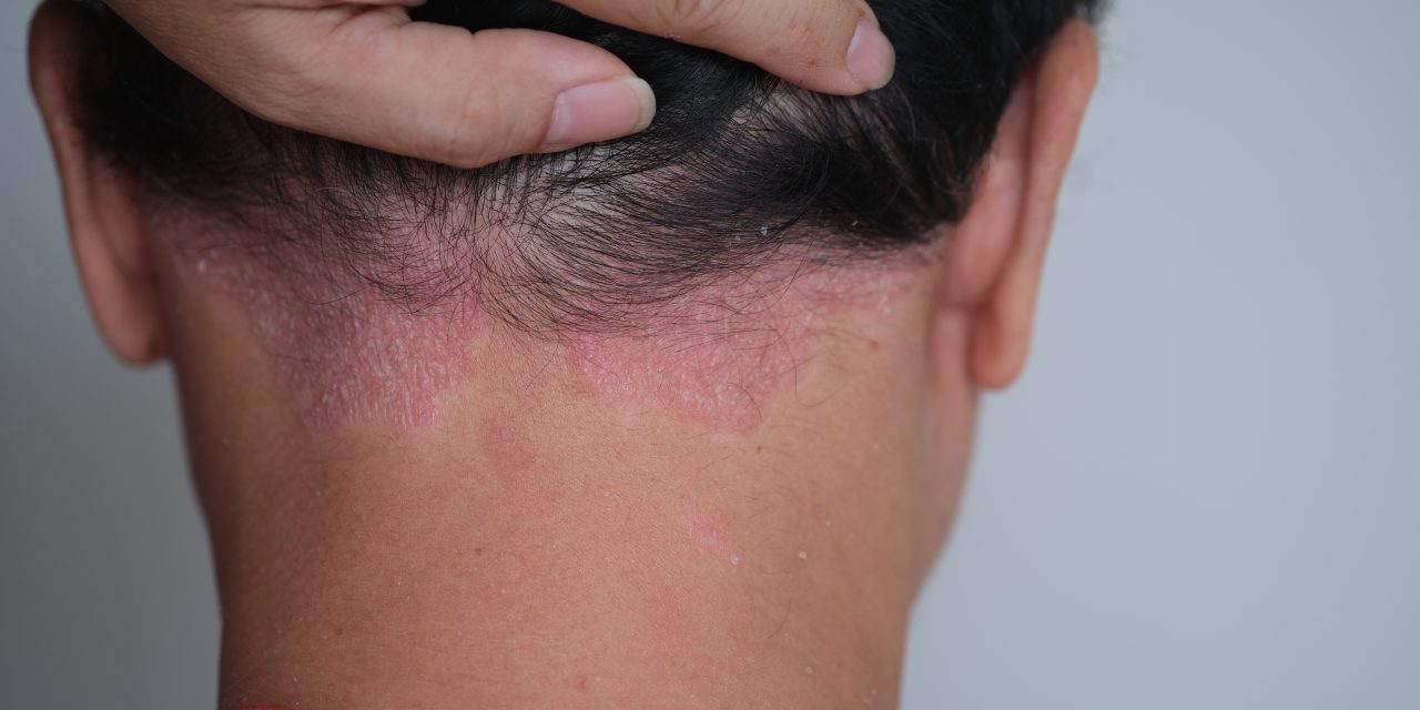 Hautleiden Schuppenflechte – wenn die Haut juckt und schuppt …