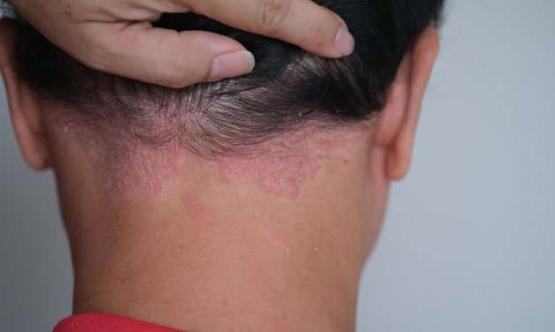 Hautleiden Schuppenflechte – wenn die Haut juckt und schuppt …