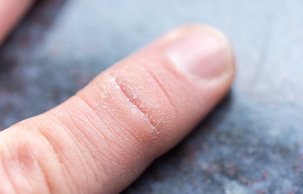 Trockene und rissige Haut: Was sich machen lässt