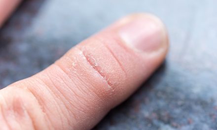 Trockene und rissige Haut: Was sich machen lässt
