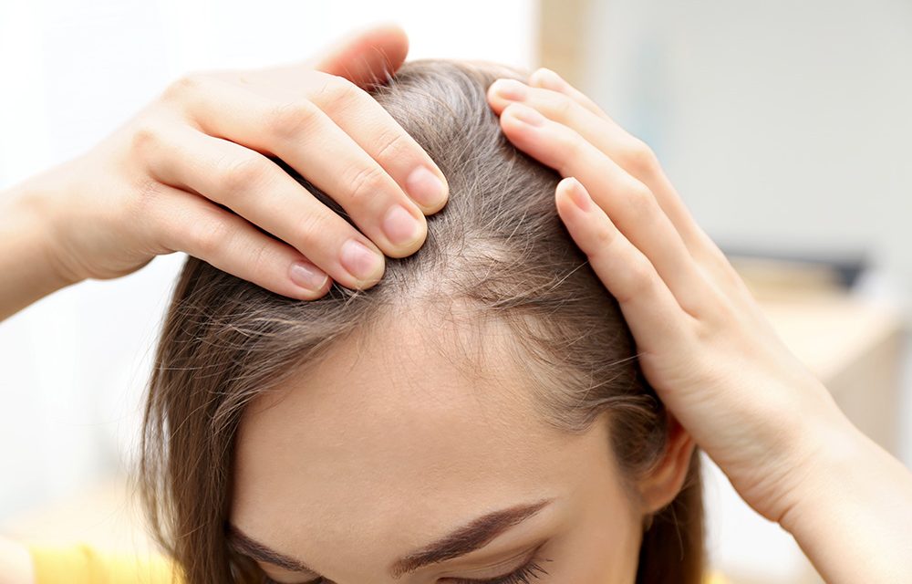 Haarausfall – kreisrunder Haarausfall bei Frauen
