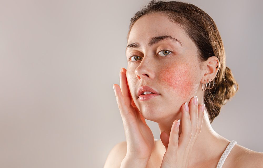 Rosacea – chronische, entzündliche Hauterkrankung
