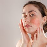 Rosacea – chronische, entzündliche Hauterkrankung