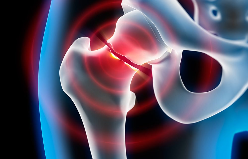 Oberschenkelhalsbruch – medial oder lateral