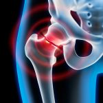 Oberschenkelhalsbruch – medial oder lateral