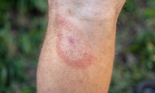 Borreliose und FSME – Informationen zum Zeckenschutz