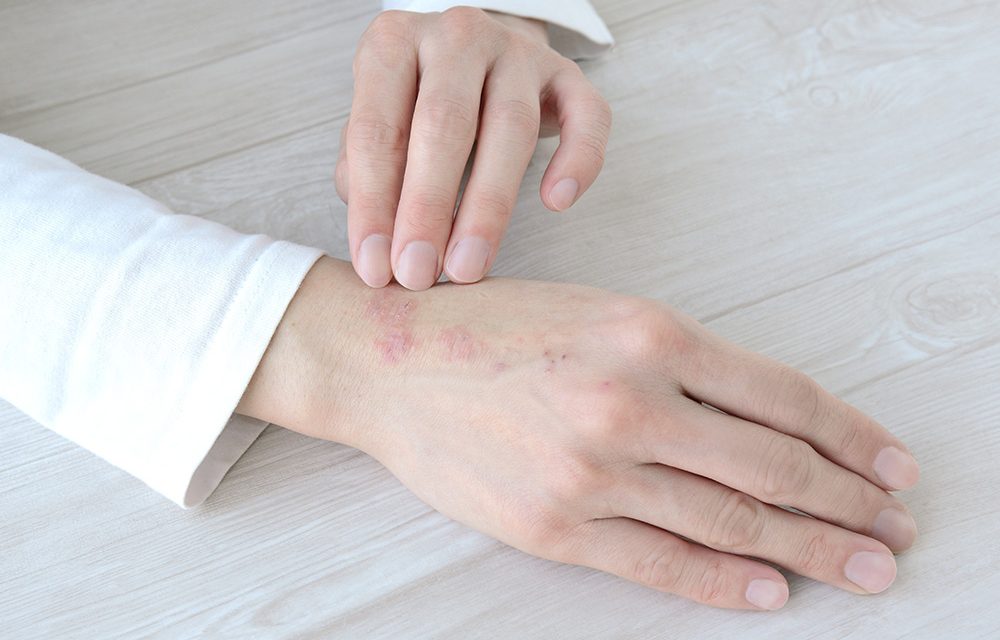 Neurodermitis: Wenn die Haut juckt und intensive Pflege braucht