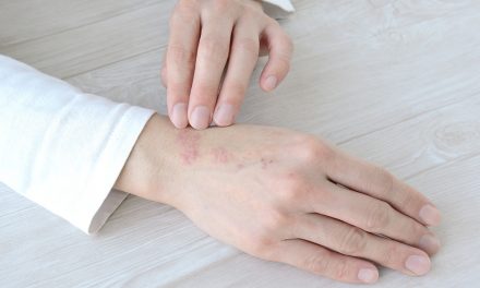 Neurodermitis: Wenn die Haut juckt und intensive Pflege braucht