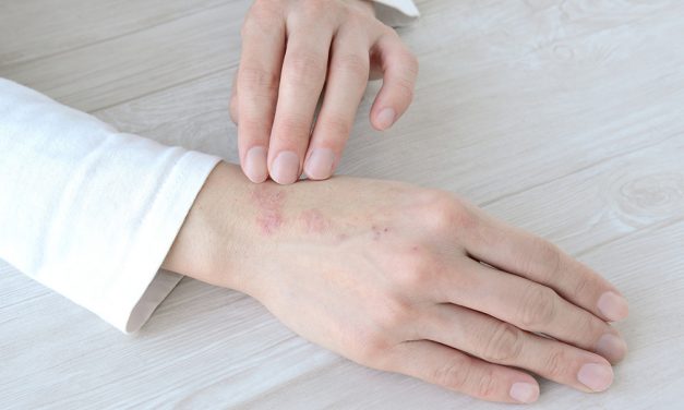 Neurodermitis: Wenn die Haut juckt und intensive Pflege braucht