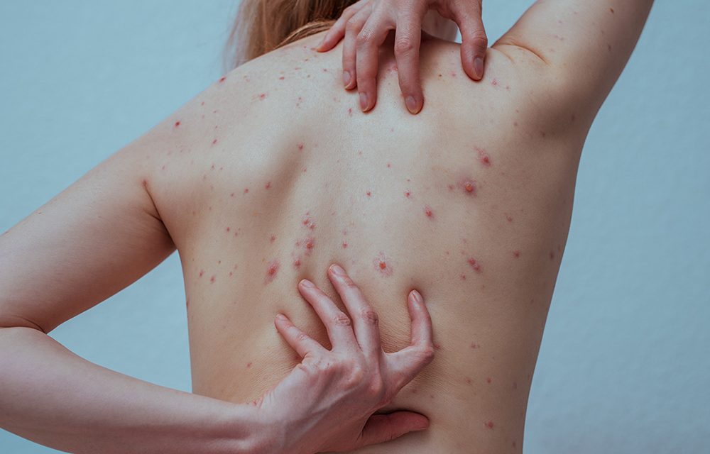 Windpocken – die ansteckende Viruskrankheit