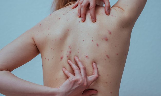 Windpocken – die ansteckende Viruskrankheit