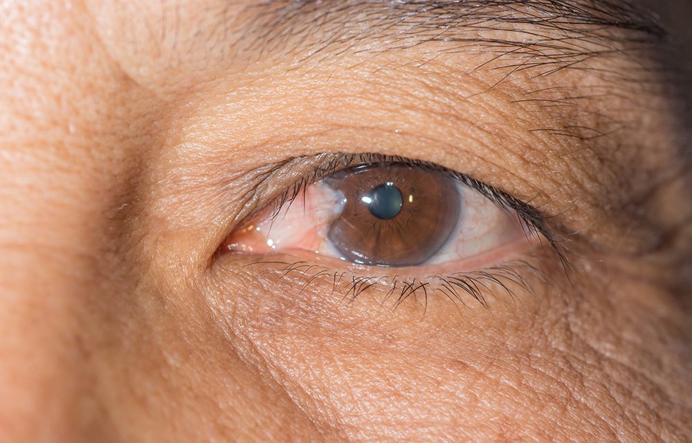 Grüner Star: ein Star, den keiner haben will