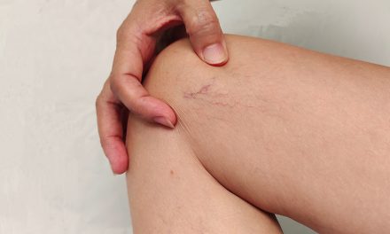 Krampfadernleiden bei Frauen und Männern