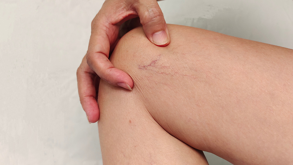 Krampfadernleiden bei Frauen und Männern