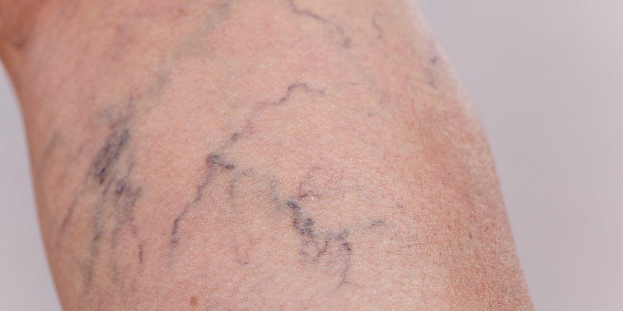 Besenreiser und Krampfadern – Muss man damit ewig leben?