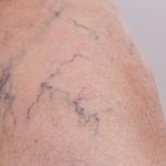 Besenreiser und Krampfadern – Muss man damit ewig leben?