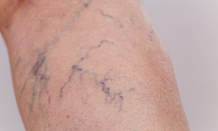 Besenreiser und Krampfadern – Muss man damit ewig leben?