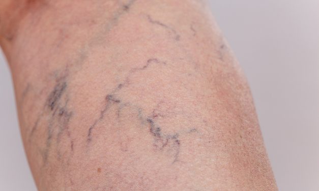Besenreiser und Krampfadern – Muss man damit ewig leben?