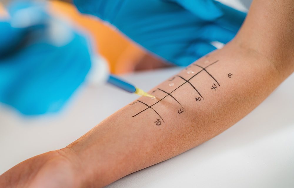 Allergien: Ursachen und Behandlungsmethoden