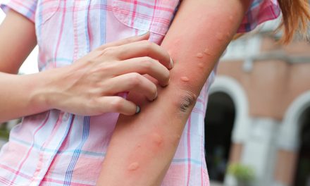 Insektenstiche – Sommerzeit ist Insektenzeit