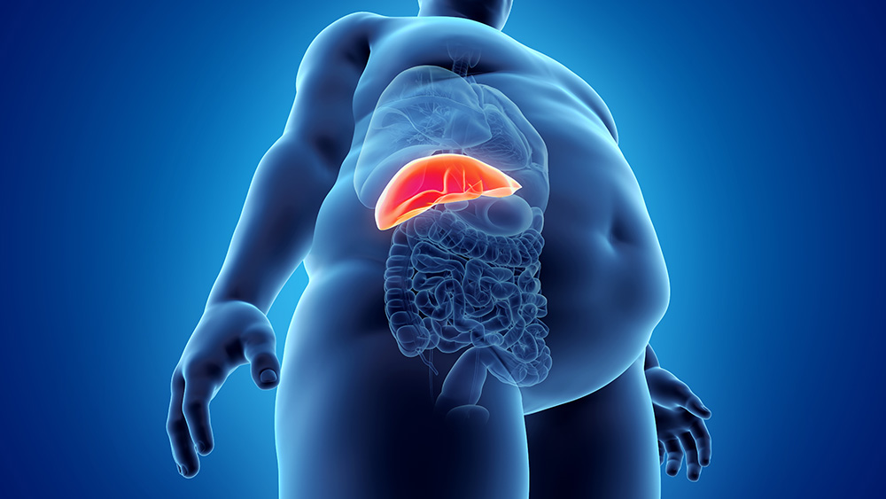 Volkskrankheit Fettleber