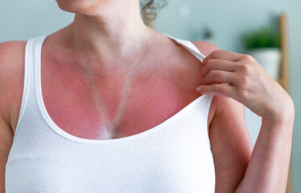 Sonnenstich und Sonnenbrand, Maßnahmen die Sie treffen sollten!