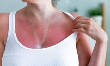 Sonnenstich und Sonnenbrand, Maßnahmen die Sie treffen sollten!