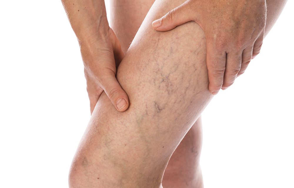 Krampfadern vorbeugen mit Ausdauersport und Wechselduschen