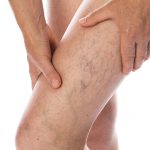 Krampfadern vorbeugen mit Ausdauersport und Wechselduschen